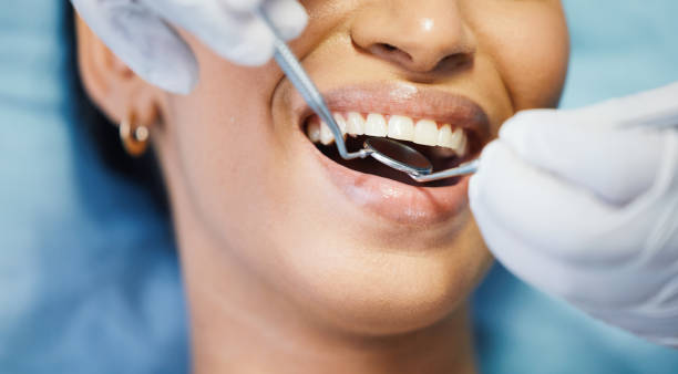 Best Chipped Tooth Repair Near Me  in Solon, IA
