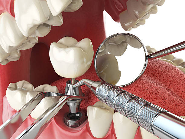 Best Chipped Tooth Repair Near Me  in Solon, IA